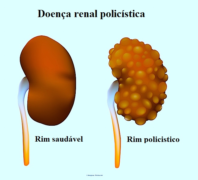 Rins policísticos: sintomas, diagnóstico e tratamento